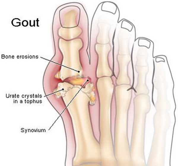 Gout Treatment In Homeopathy - Chhc