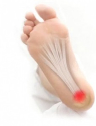 Homeopathy treatment for Heel pain - Chhc