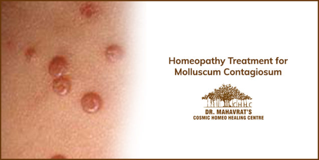 Homeopathy Treatment for Molluscum Contagiosum