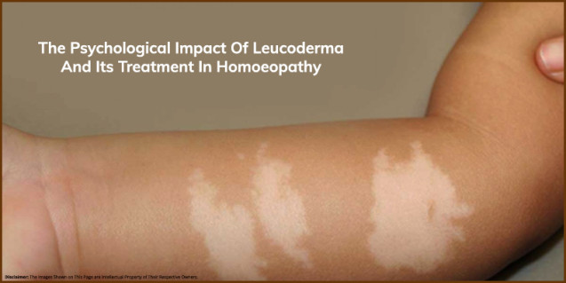 Leucoderma and Its Treatment