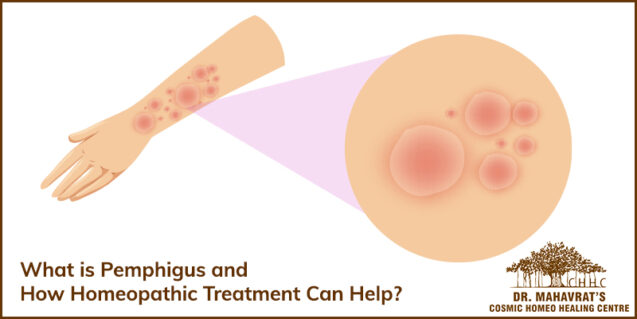 Pemphigus