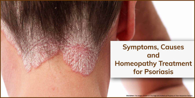 Symptoms, Causes and Homeopathy Treatment for Psoriasis