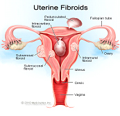 Uterine Fibroids Cosmic Homeo haling Centre