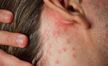 Skin rashes treatment - Cosmic Homeo haling Centre