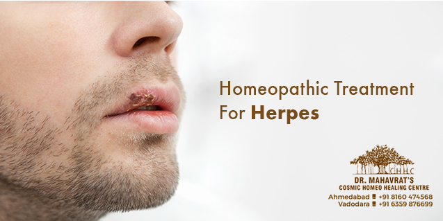 Homeopathic Treatment For Herpes
