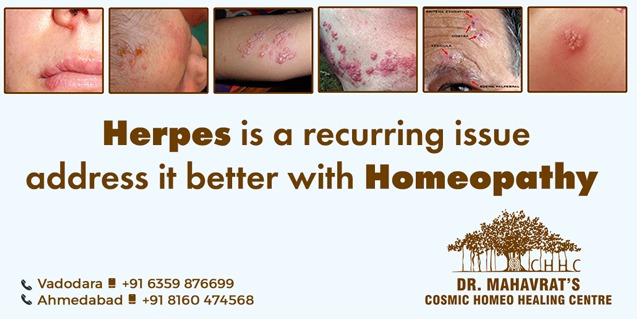 Herpes is recurring issue treatment with homeopathy
