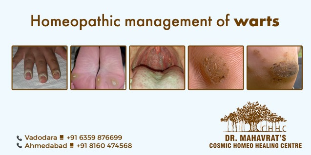 Homeopathic Management of Warts