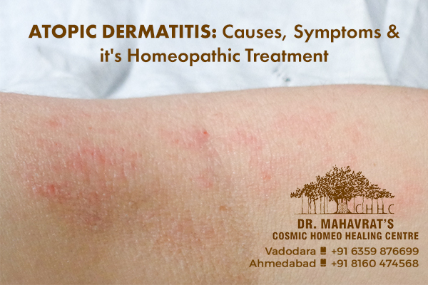 Atopic Dermatitis : Causes, Symptoms & it's Homeopathic Treatment