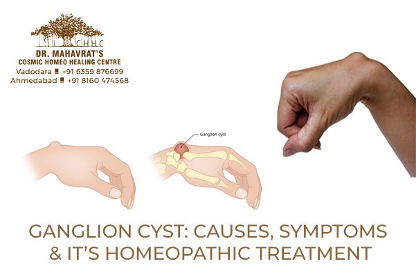 GANGLION CYST: Causes, Symptoms & it’s Homeopathic Treatment