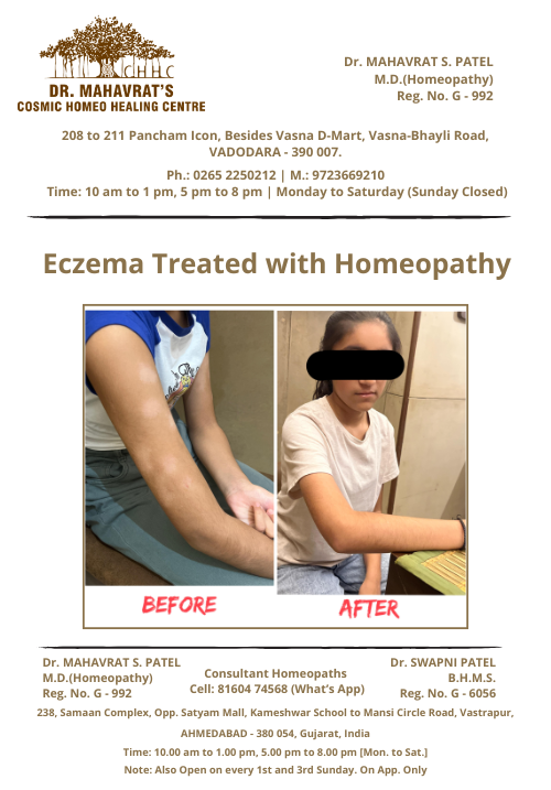 Eczema