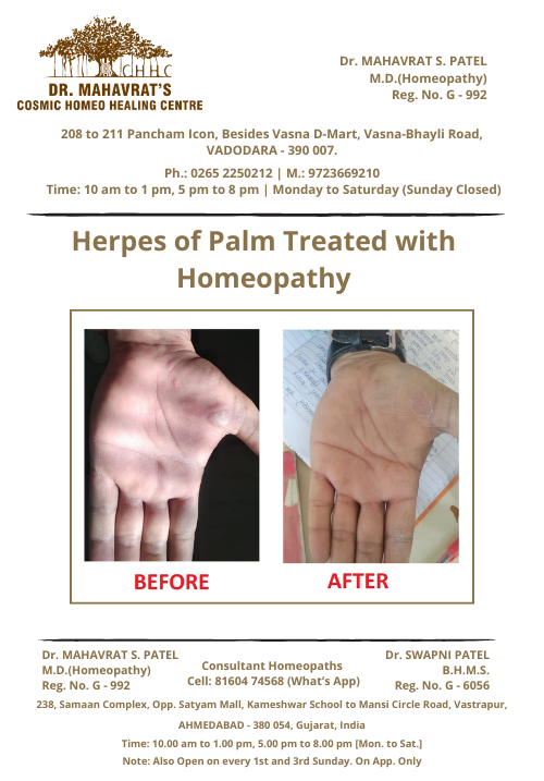 Herpes-of-palm