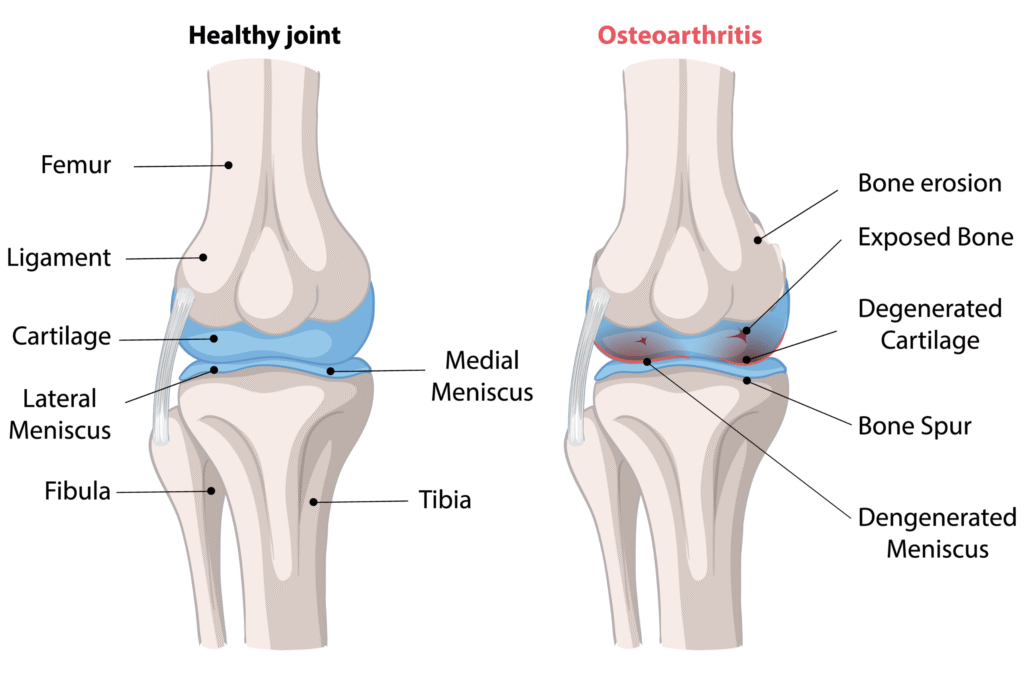 symptoms of Osteoarthritis
