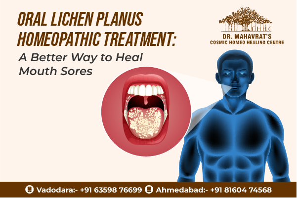 Oral lichen planus homeopathic treatment