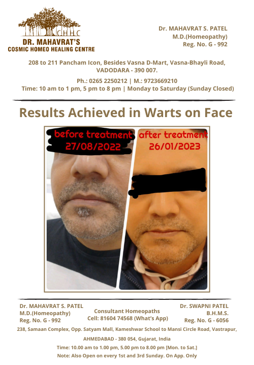 Warts-on-face