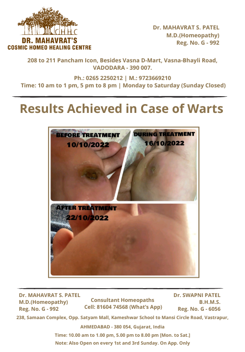 Warts
