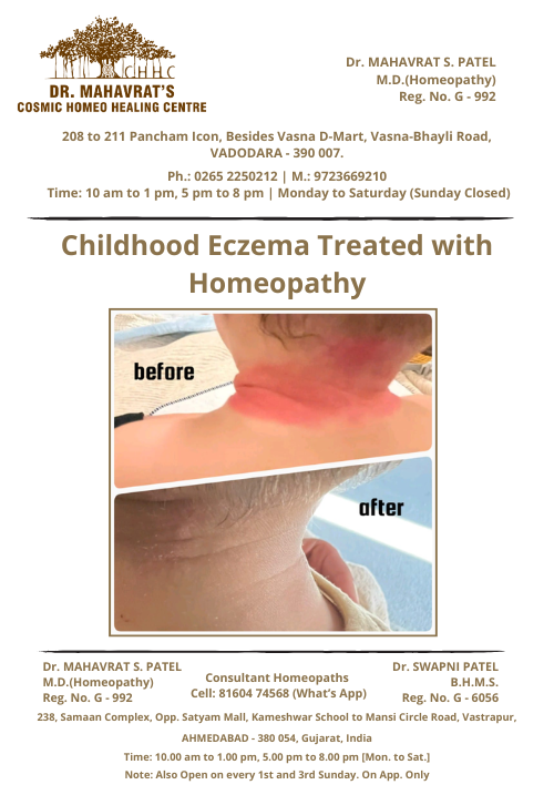 childhood-eczema
