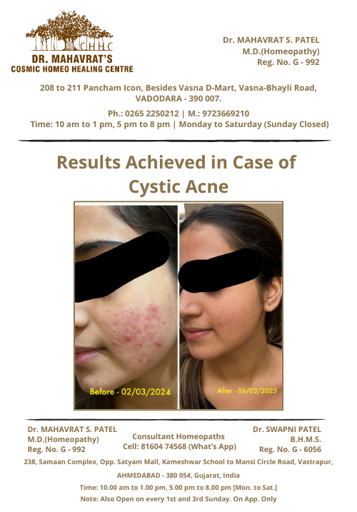 cystic-acne