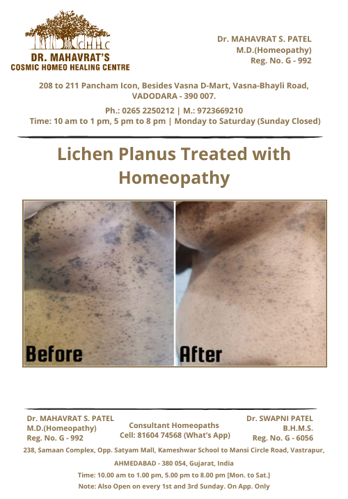 lichen-planus