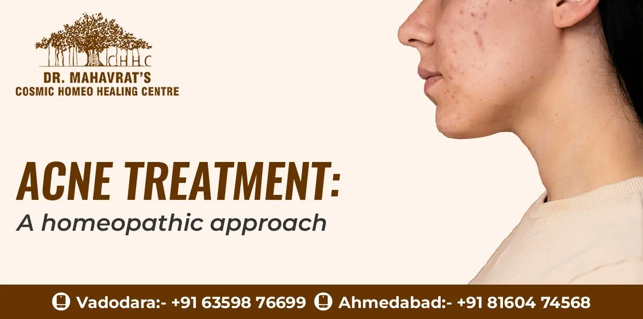 Acne treatment: A homeopathic approach-chhc