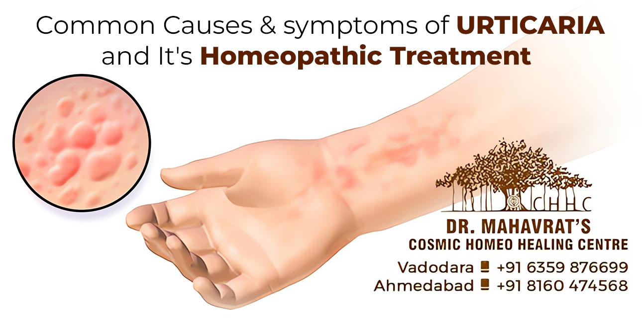 Common Causes & Symptoms Of Urticaria And It’s Homeopathic Treatment