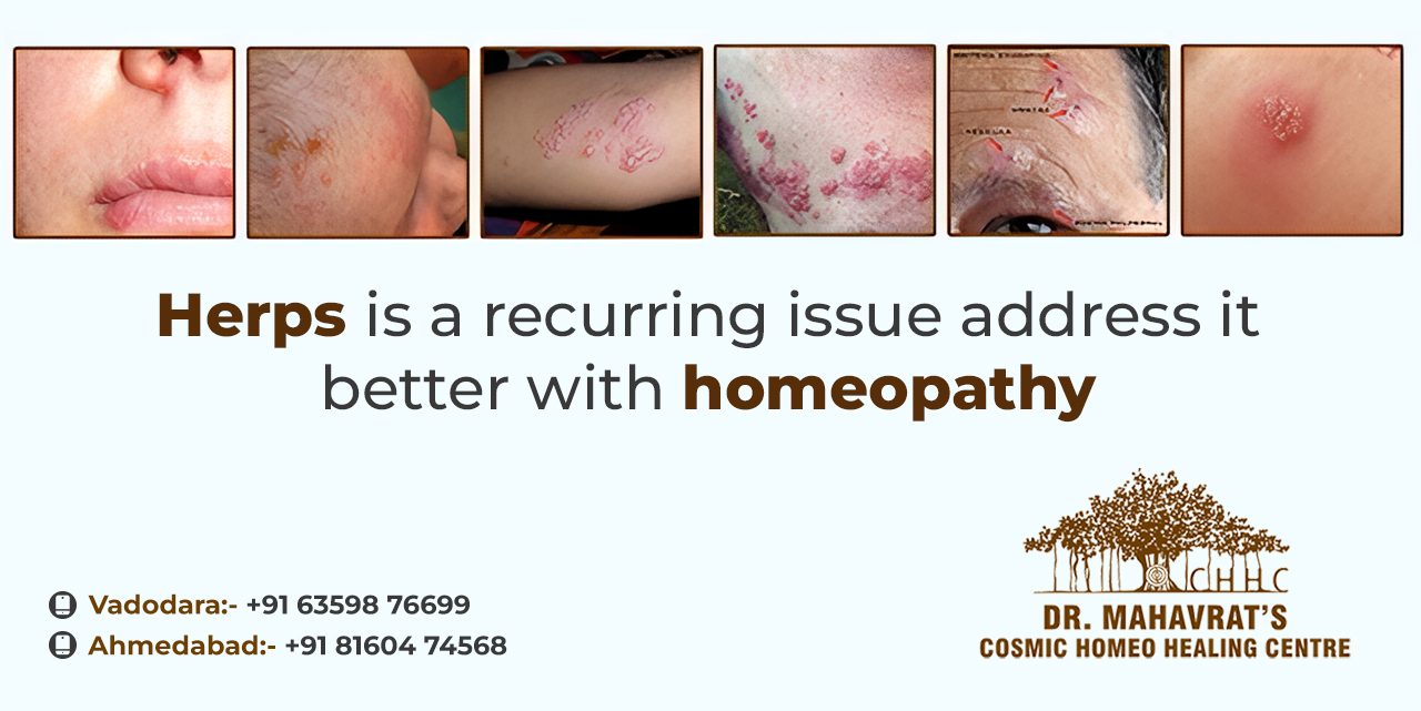 Herpes treatment with homeopathy