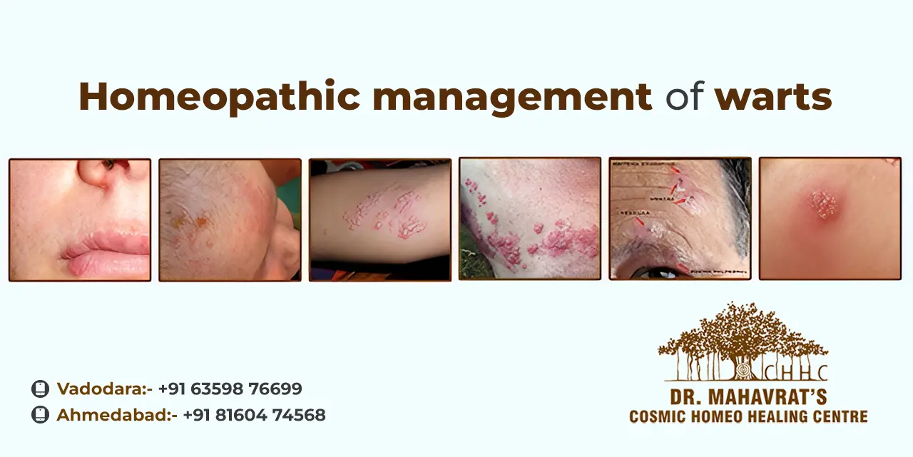 Homeopathic Management of Warts