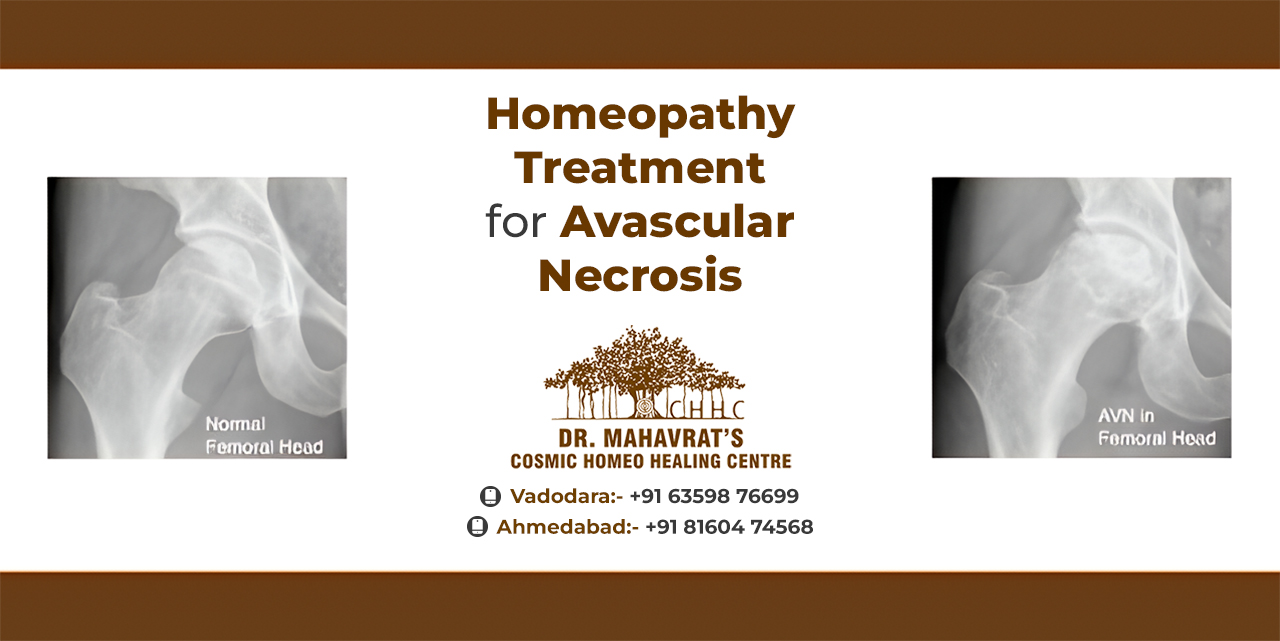 Homeopathy Treatment for Avascular Necrosis