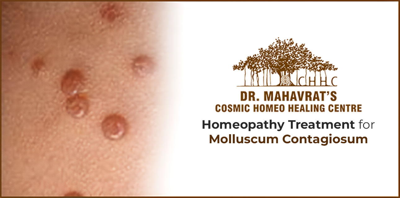 Homeopathy Treatment for Molluscum Contagiosum