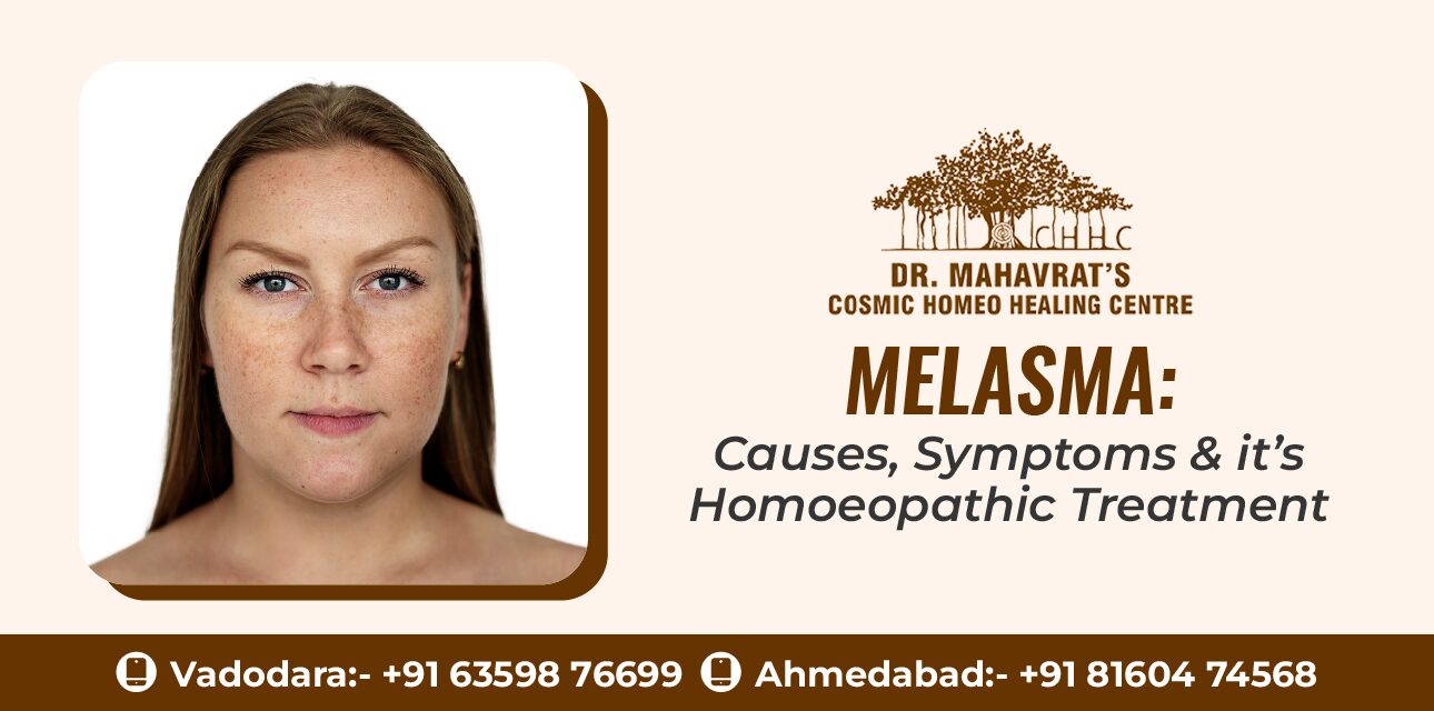 Melasma- Causes, Symptoms & it’s Homoeopathic Treatment-chhc