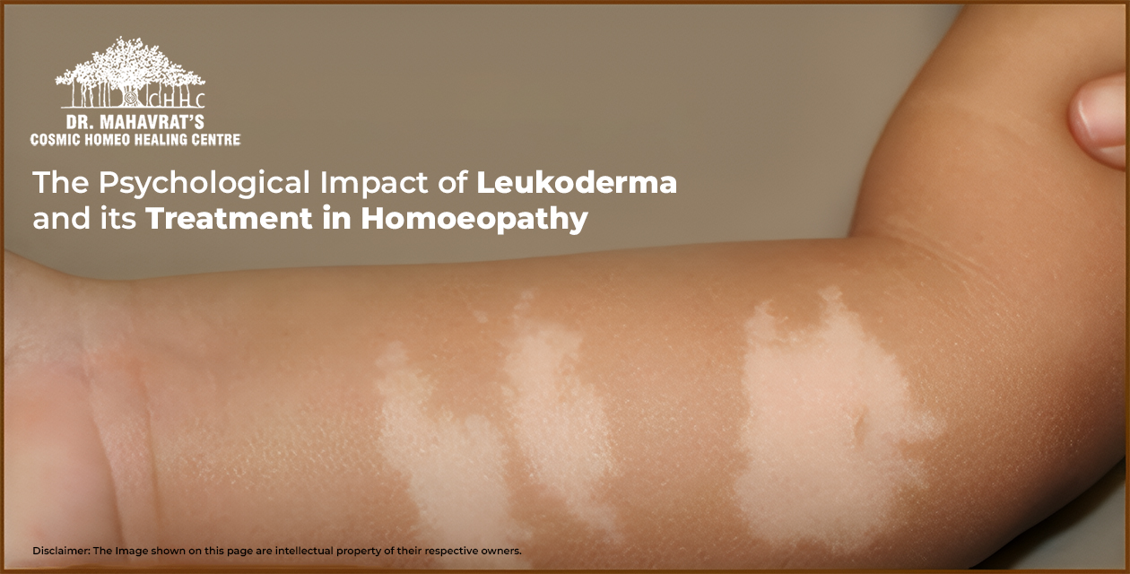 The Psychological Impact of Leukoderma and its Treatment in Homoeopathy