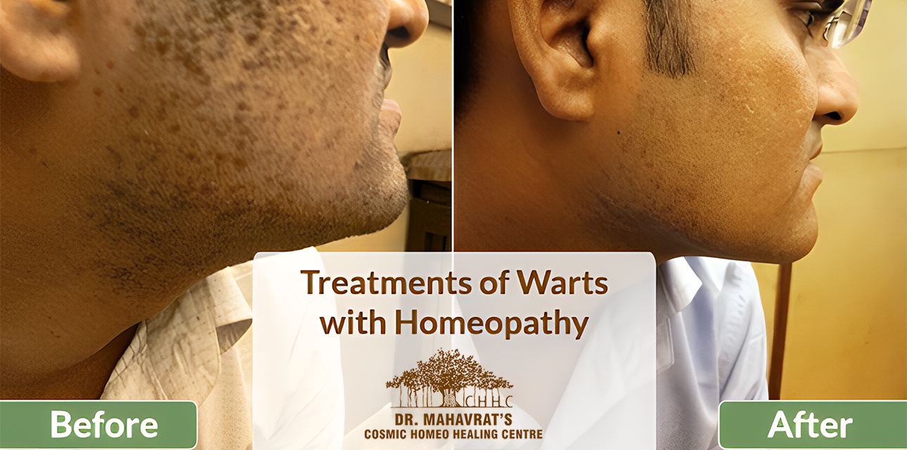 Treatments of Flat Warts with Homeopathy