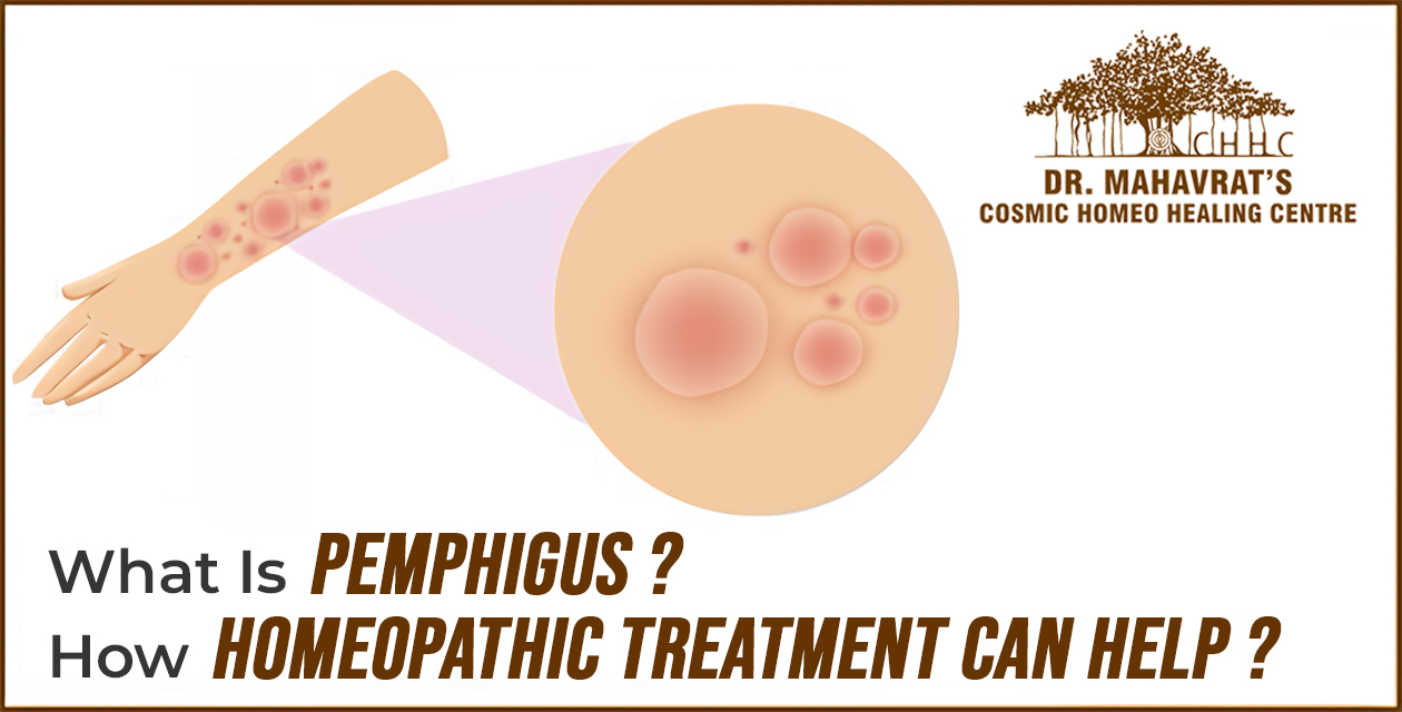 What Is Pemphigus And How Homeopathic Treatment Can Help