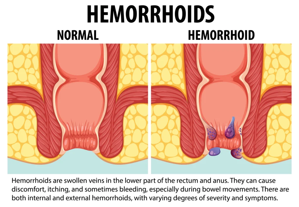 Comparing Normal and Internal Hemorrhoid: An Educational Infogra