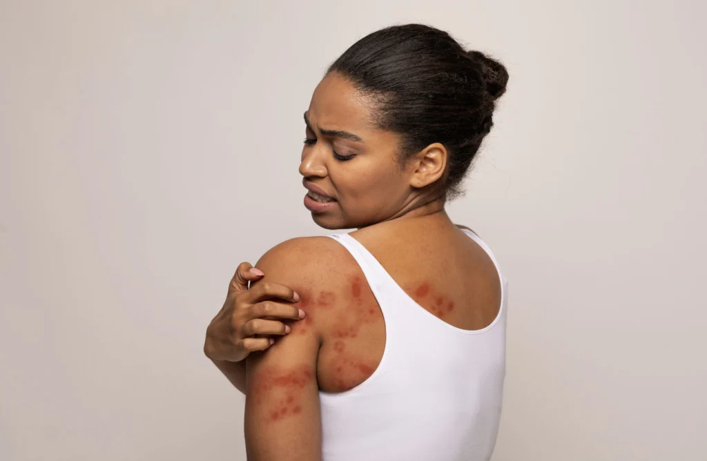 Black woman scratching red spots on her skin