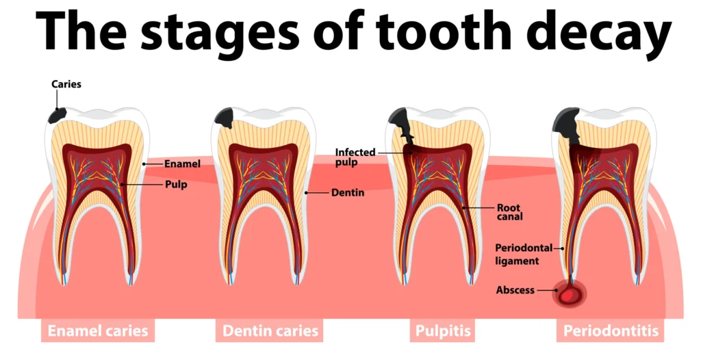 Infographic of human in the stages of tooth decay