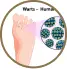 warts