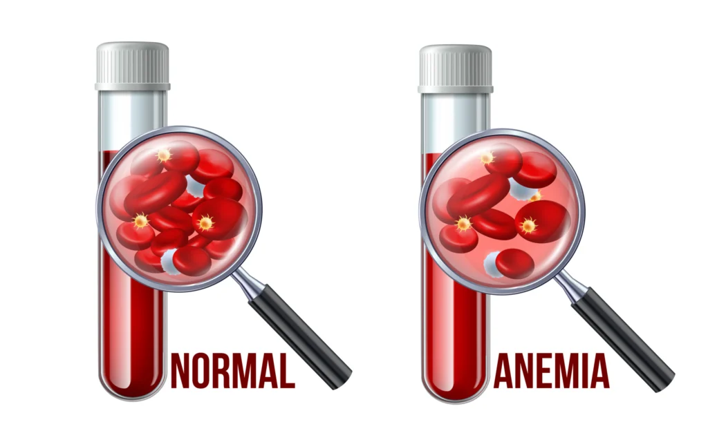 Iron deficiency anemia.The difference of Anemia amount of red blood cell and normal. Medical icon