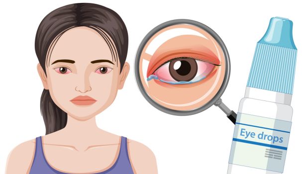 Conjunctivitis-CHHC