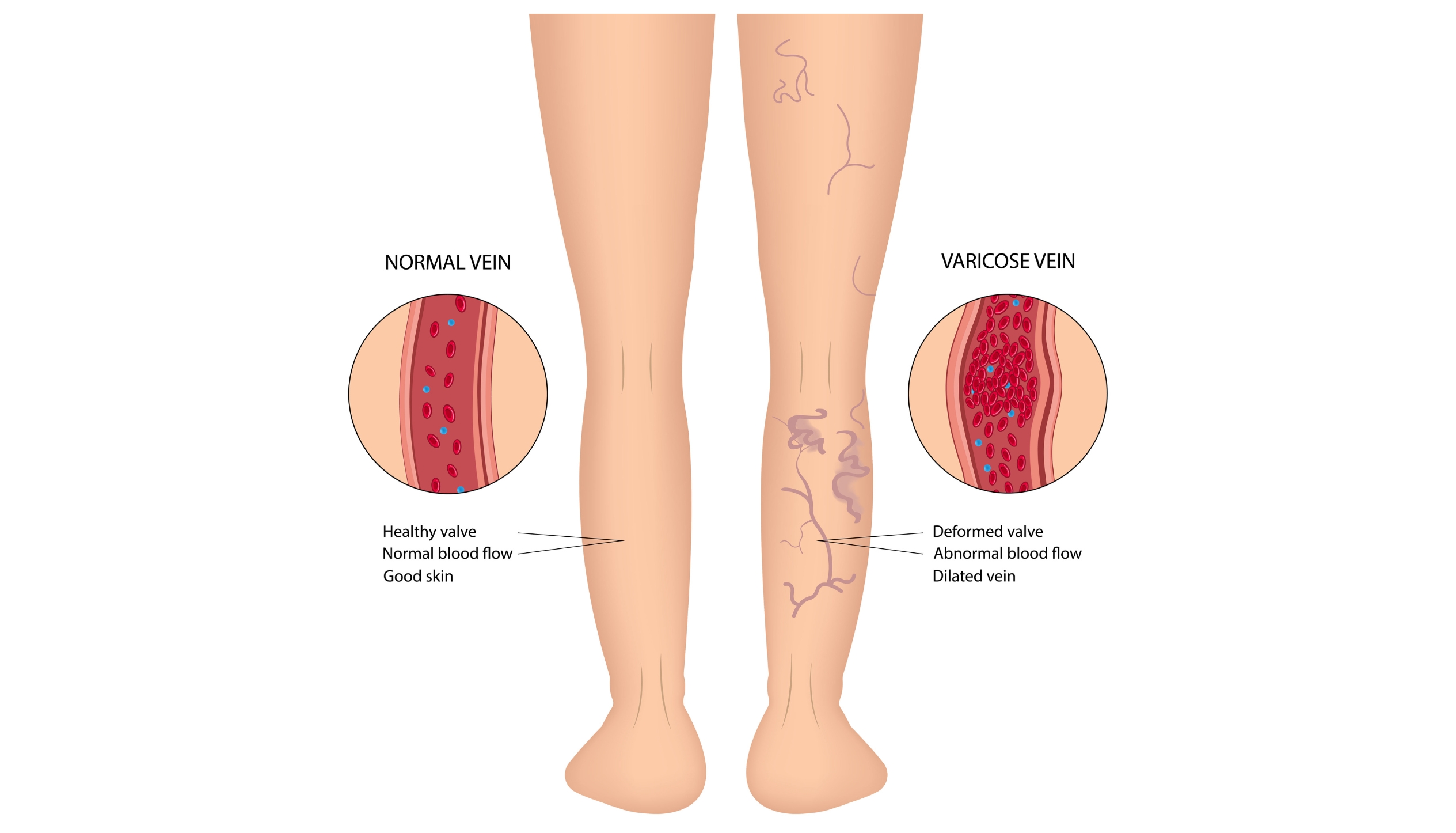 Varicose Vein and Ulcer - CHHC