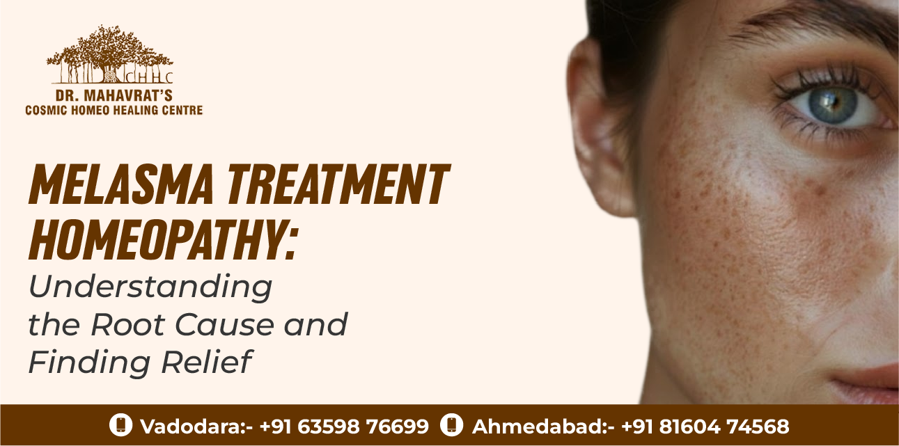 melasma treatment homeopathy